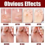 Foot Corn Removal Extra Strengthen Gel(10 ML) - Image 6