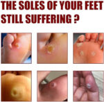 Foot Corn Removal Extra Strengthen Gel(10 ML) - Image 5