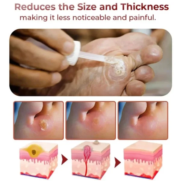 Foot Corn Removal Extra Strengthen Gel(10 ML) - Image 4