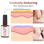 Foot Corn Removal Extra Strengthen Gel(10 ML) - Image 3