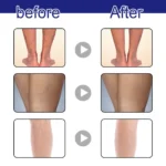 OUHOE Varicose Veins Treatment Spray!! - Image 2