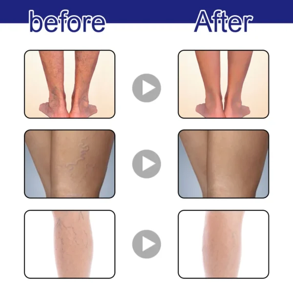 OUHOE Varicose Veins Treatment Spray!! - Image 2