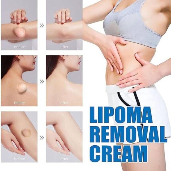 2 PC -South Moon™ Lipoma Treatment Ointment Cream - Image 2