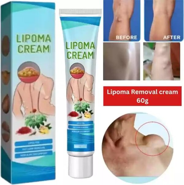 2 PC -South Moon™ Lipoma Treatment Ointment Cream - Image 3
