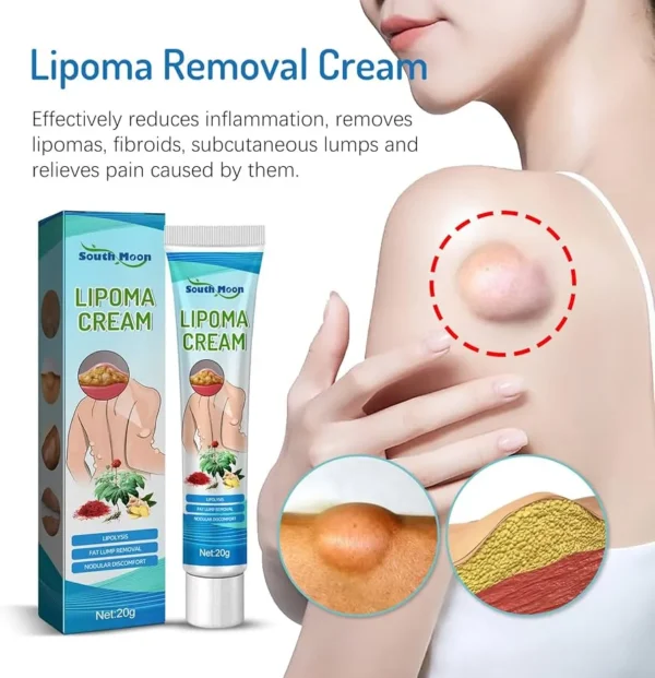 2 PC -South Moon™ Lipoma Treatment Ointment Cream - Image 1