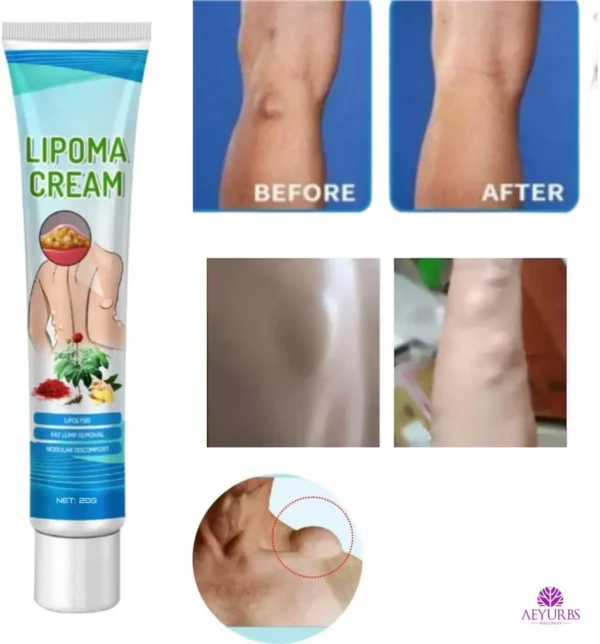 2 PC -South Moon™ Lipoma Treatment Ointment Cream - Image 7