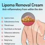 South Moon™ Lipoma Treatment Ointment Cream - Image 2