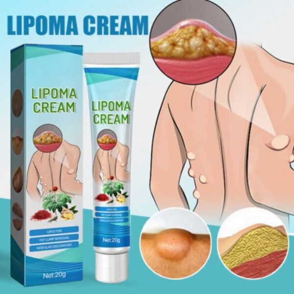 South Moon™ Lipoma Treatment Ointment Cream - Image 4